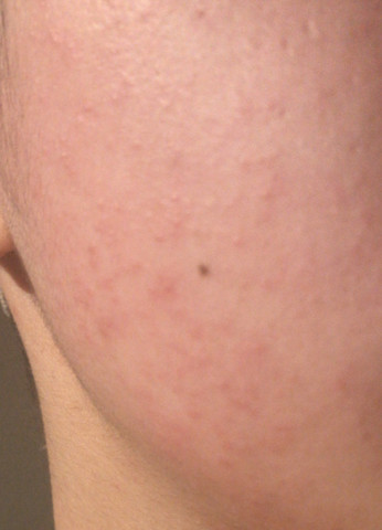 Hautausschlag Im Gesicht Warum Gesundheit Und Medizin Haut Pickel