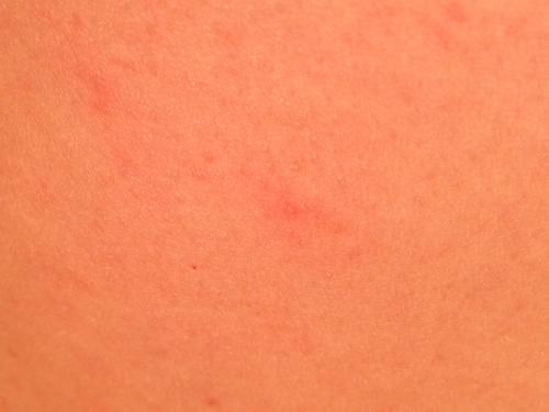 hund juckreiz fenistil