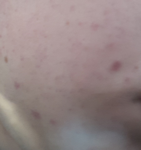 Alkohol bei rote flecken Hautausschlag (Exanthem):