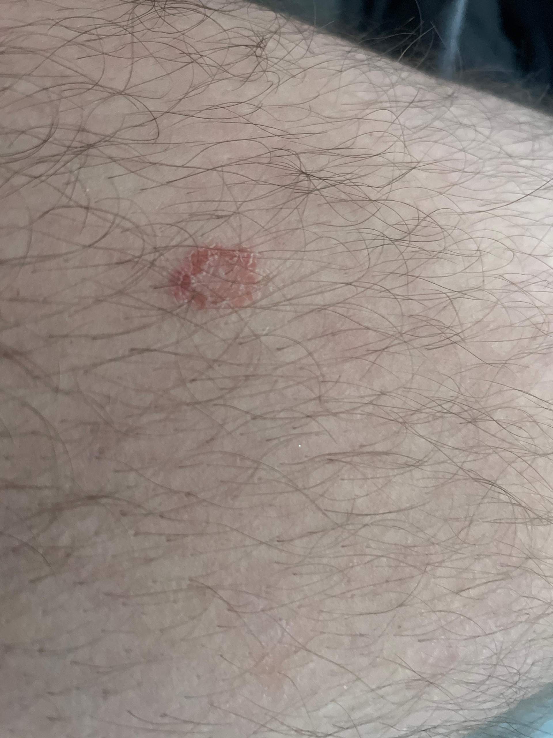 Hautausschlag rund rot schuppig am Körper und blasen auf der Zunge ? (Gesundheit und Medizin Hautausschlag rund rot schuppig am Körper und blasen auf der Zunge ? (Gesundheit und Medizin