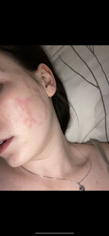 Hautausschlag so schonmal gesehen? (Gesundheit und Medizin, Haut) Hautausschlag so schonmal gesehen? (Gesundheit und Medizin, Haut)