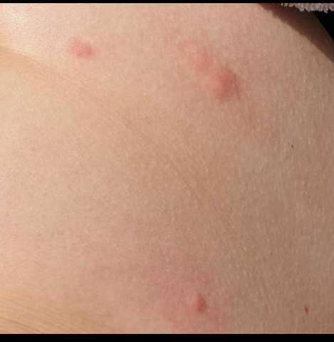 Ausschlag mückenstich ähnlicher Komischer Hautausschlag,