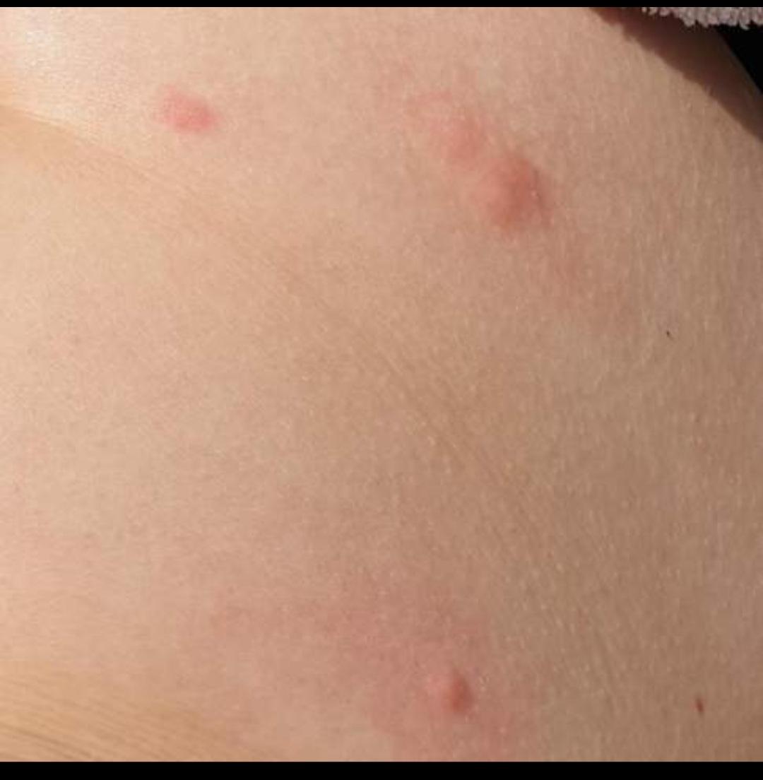Hautausschlag über dem Körper verteilt? (Gesundheit und Medizin)