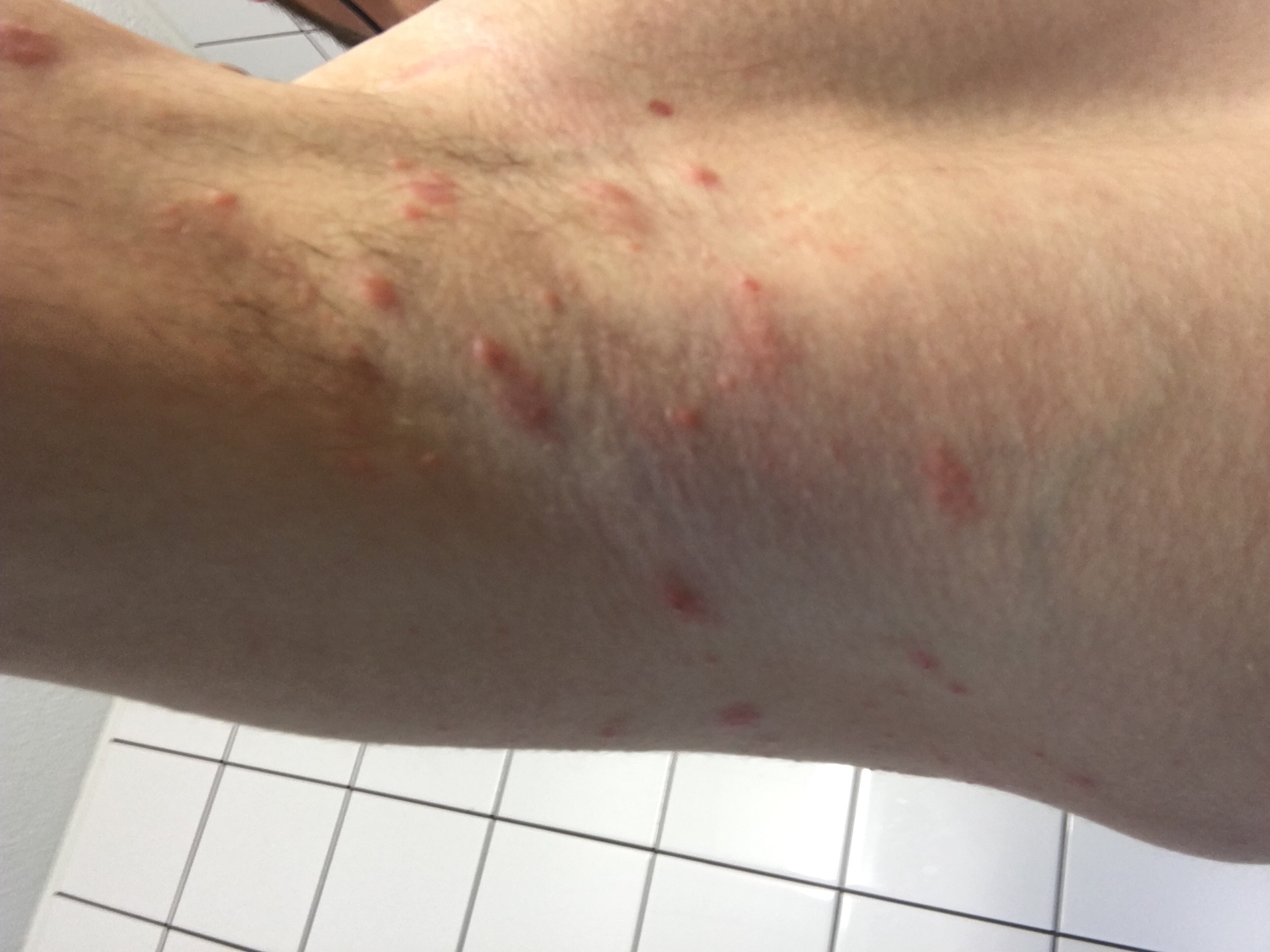 Hautausschlag Unter Den Achseln Was Tun Gesundheit Medizin Menschen Hautausschlag Unter Den Achseln Was Tun Gesundheit Medizin Menschen