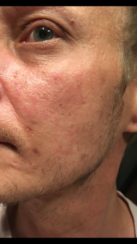 Hautausschlag Wange Links Haut Hautausschlag Wange Links Haut