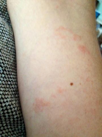 Hautausschlag Was Ist Das Medizin Hauterkrankung Hautausschlag Was Ist Das Medizin Hauterkrankung