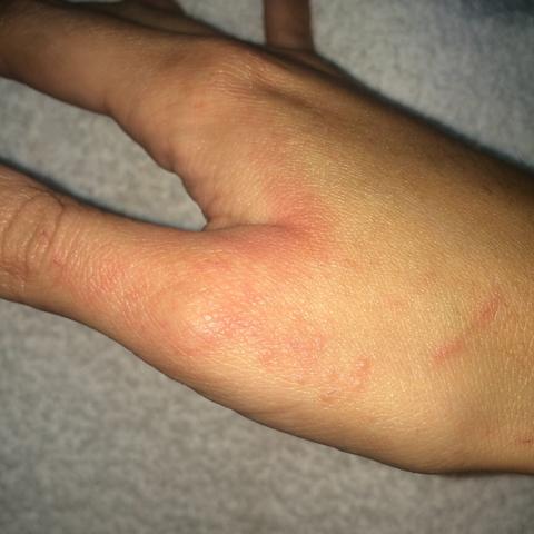 Die Bläschen  - (Haut, Allergie, Ausschlag)