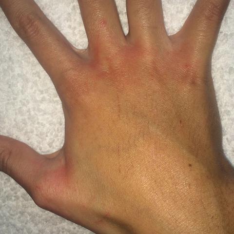 Bild 1 - (Haut, Allergie, Ausschlag)