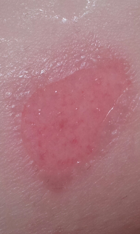 Hautentzündung? was kann das sein? (Krankheit, Haut)