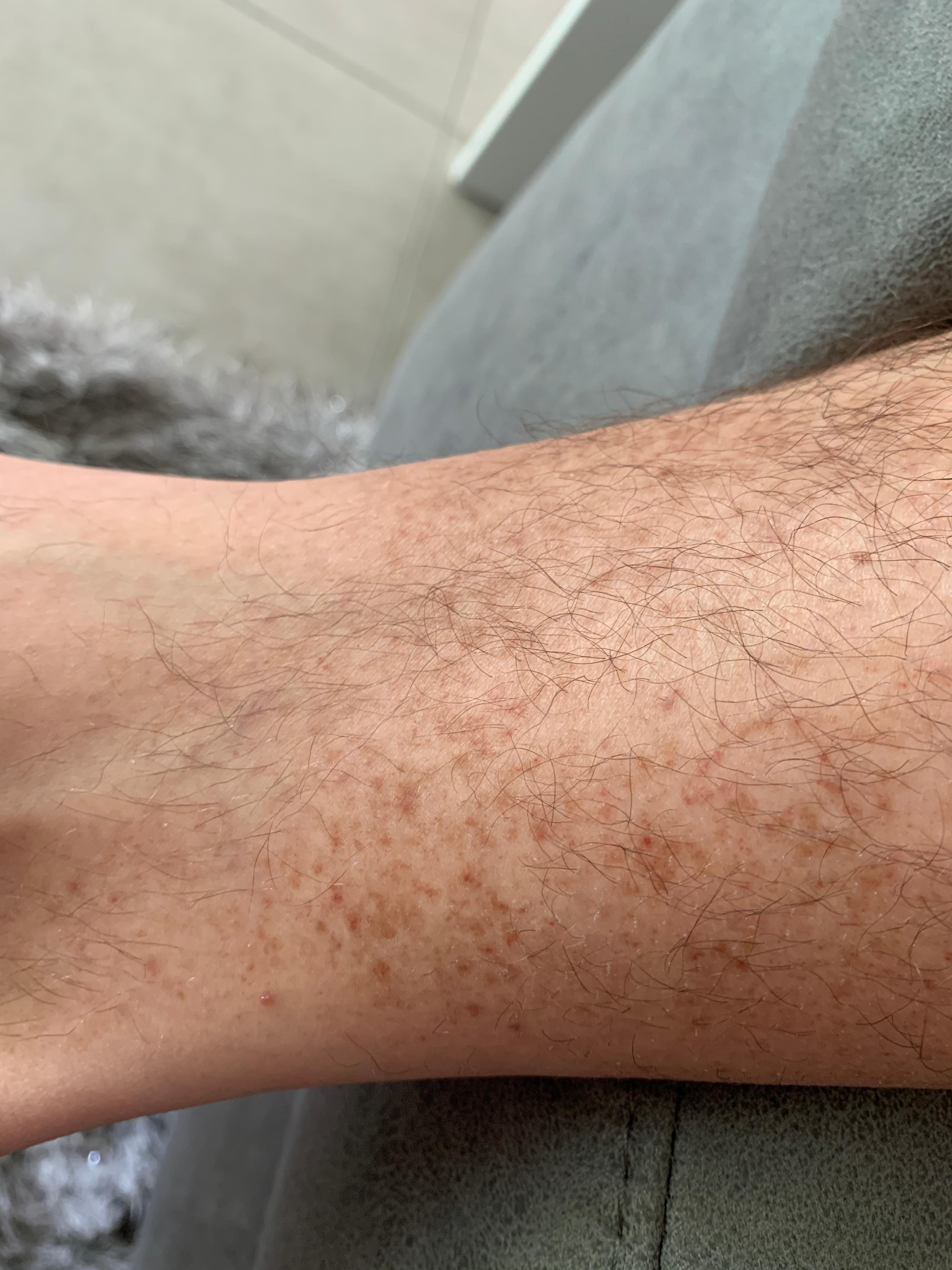 Hauterkrankung am Bein/ Fuß? (Computer, Hautpflege, Hautarzt)