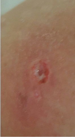 Hauterkrankung Locher In Der Haut Entzundung Hilfe Loch Hauterkrankung Locher In Der Haut Entzundung Hilfe Loch