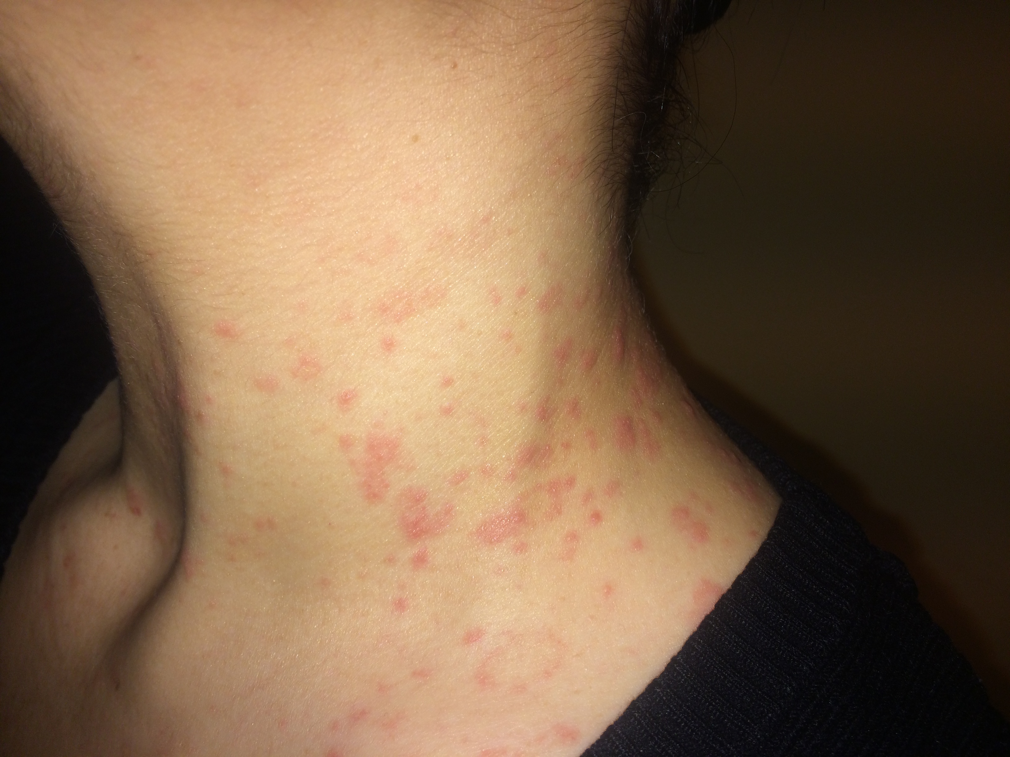 Hauterkrankung (Rote flecken) HILF! (Gesundheit, Haut) Hauterkrankung (Rote flecken) HILF! (Gesundheit, Haut)