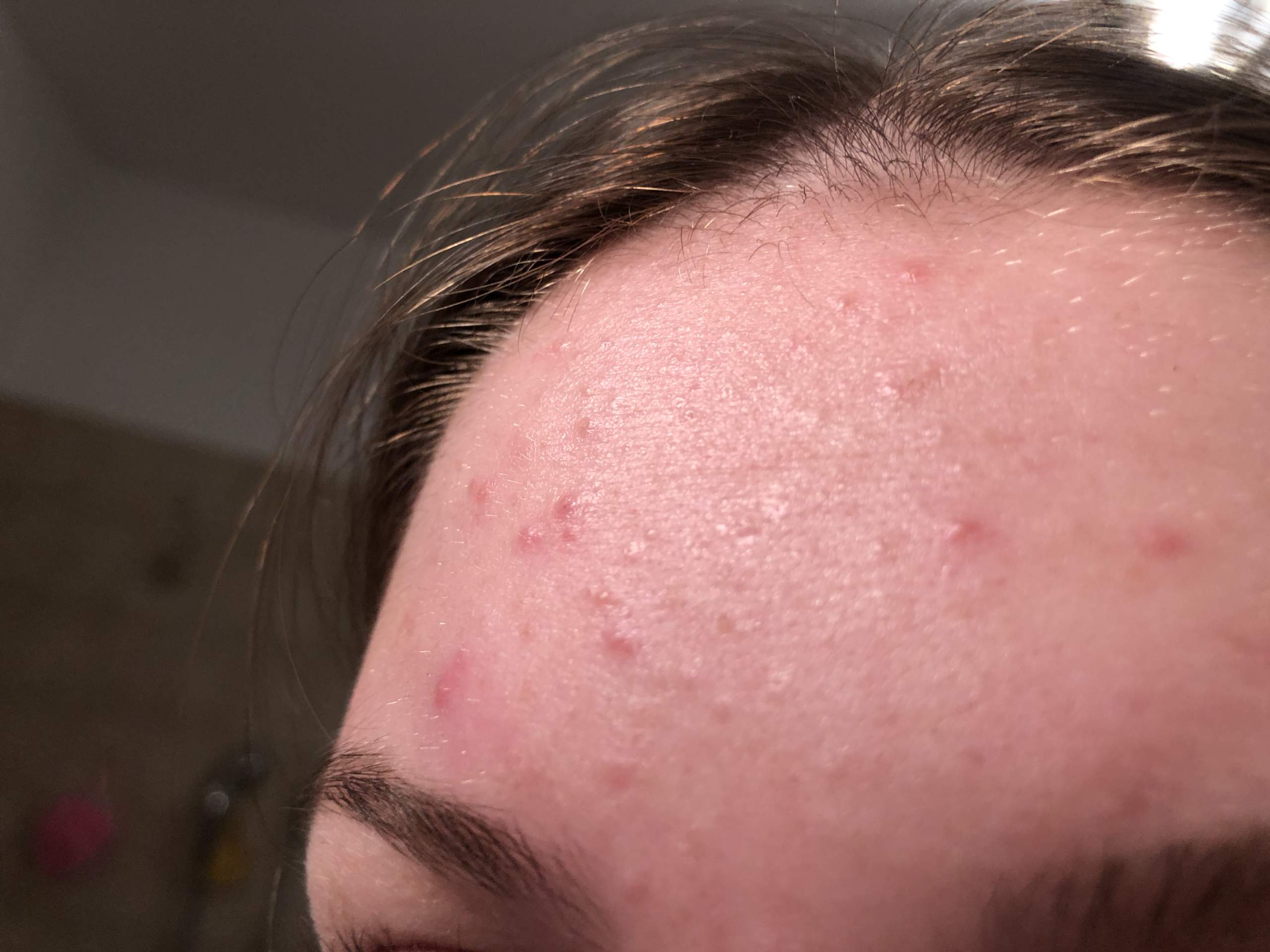 Hautfarbene Pickel auf der Stirn? (Haut) pickel auf der stirn