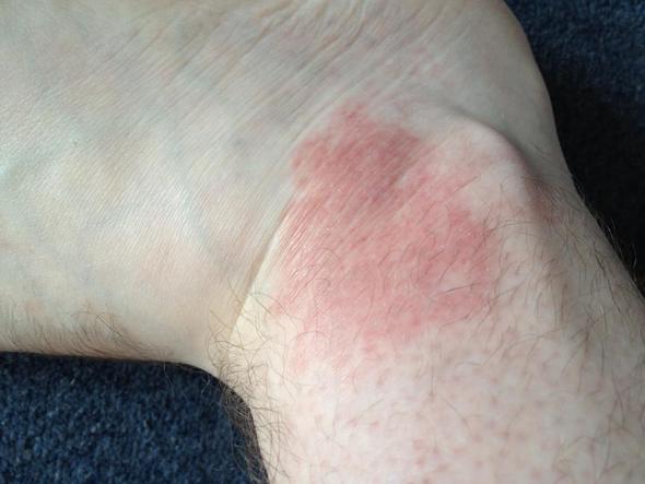 Hautirritation am Fußgelenk - (Medizin, Haut, Entzündung)