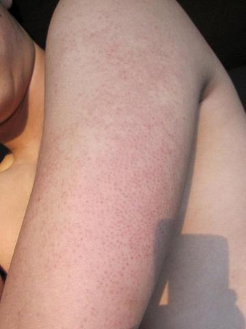 Oberarm mit den Hautirritationen - (Körper, Haut)