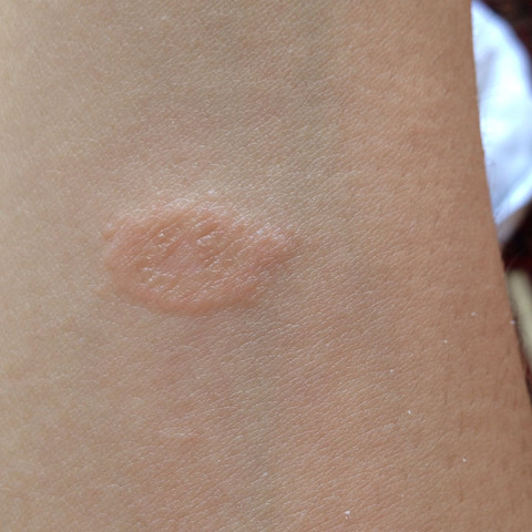 Der vermeintliche Mückenstich am Arm - (Haut, Hautarzt, Neurodermitis)