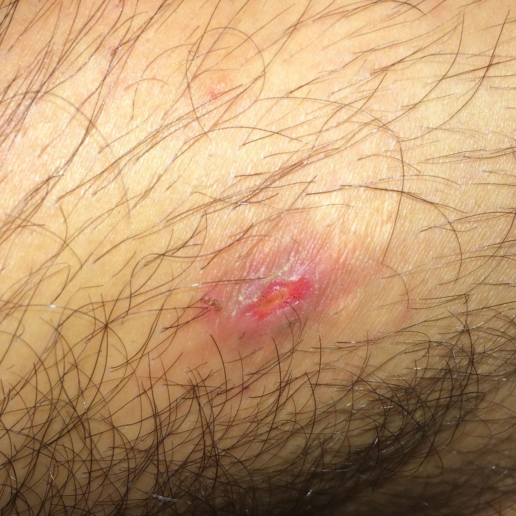 Hat den Finger neben dem Nagel angeschwollen und tut wie weh, zu behandeln