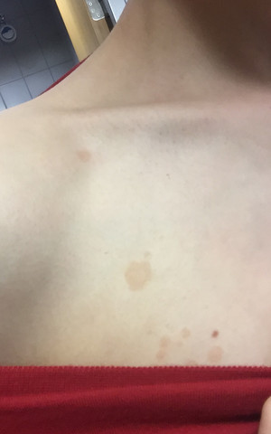 Hautkrebs Hilfe Brustseiten Arzt Haut Krebs Hautkrebs Hilfe Brustseiten Arzt Haut Krebs