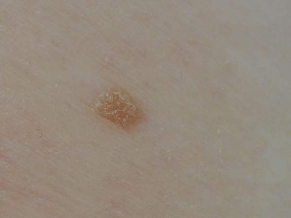 Hautkrebs Oder Doch Was Anderes Gesundheit Und Medizin Haut Dermatologie Hautkrebs Oder Doch Was Anderes Gesundheit Und Medizin Haut Dermatologie