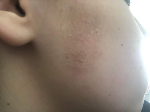 Hautkrebs Infektion Krankheit Hautprobleme