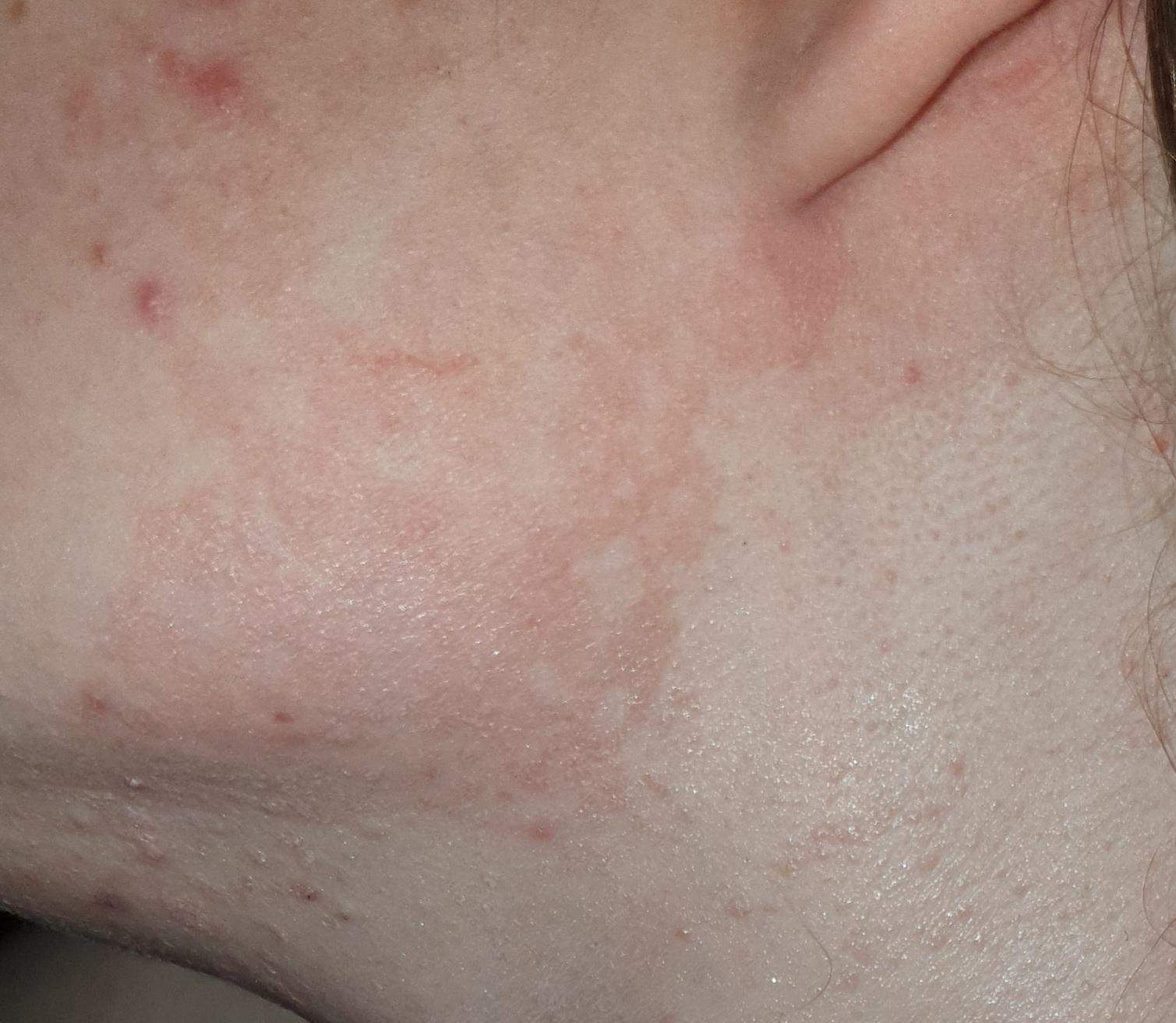 Hautpilz? (Gesundheit und Medizin)