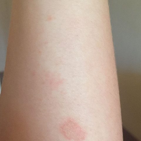 Hautpilz Der Nicht Juckt Pickel Flecken Infektion Hautpilz Der Nicht Juckt Pickel Flecken Infektion