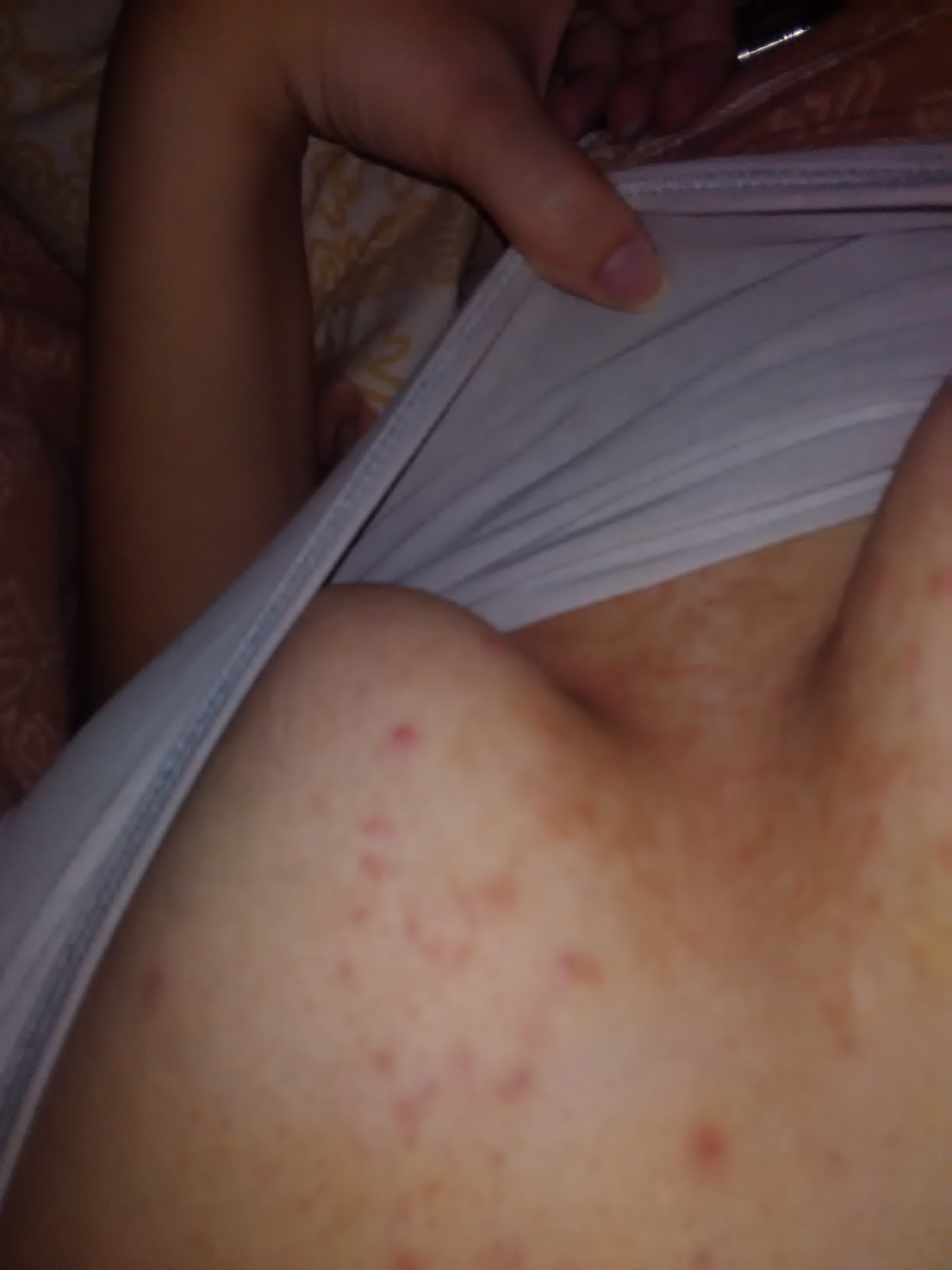 Hautpilz Geht Nicht Weg Creme Hautpilz Geht Nicht Weg Creme