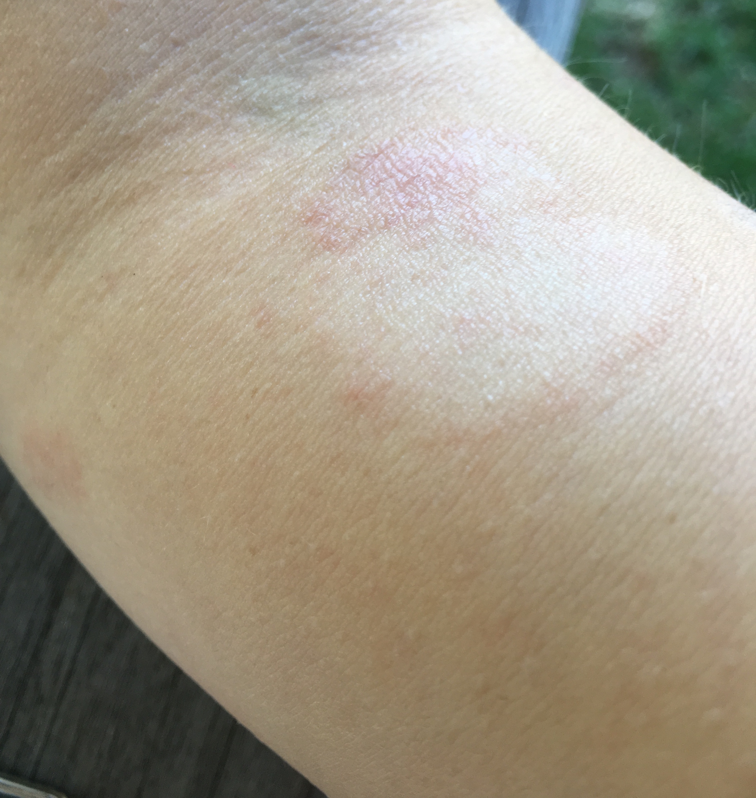 Hautpilz, Neurodemitis , Rinderflechte, Borreliose? (Hautarzt ...