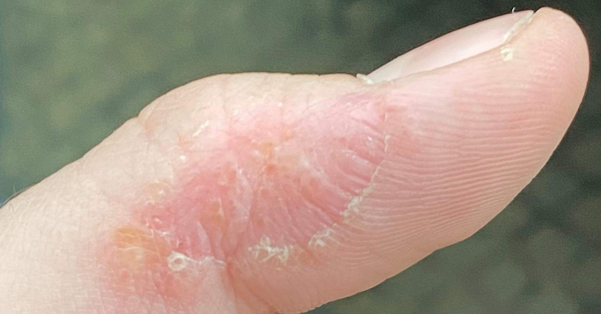 Hautpilz oder trockene Haut? (Gesundheit und Medizin)