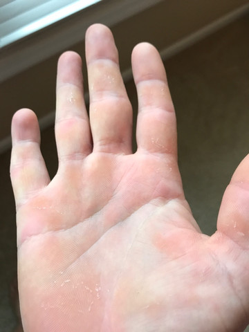 Hand  - (Hand, Hautprobleme)