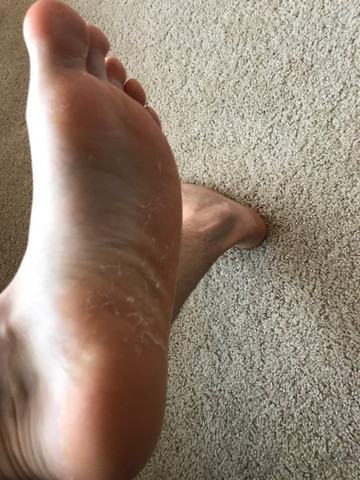 Fuß - (Hand, Hautprobleme)