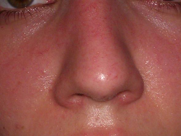 Rosacea heilerde bei 6 Gründe,