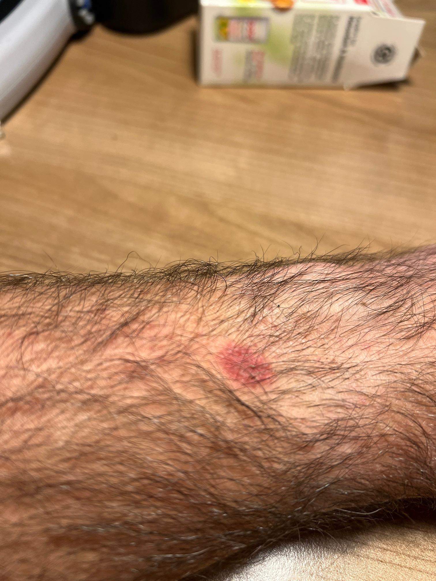 Hautreizung durch Garmin Smartwatch?