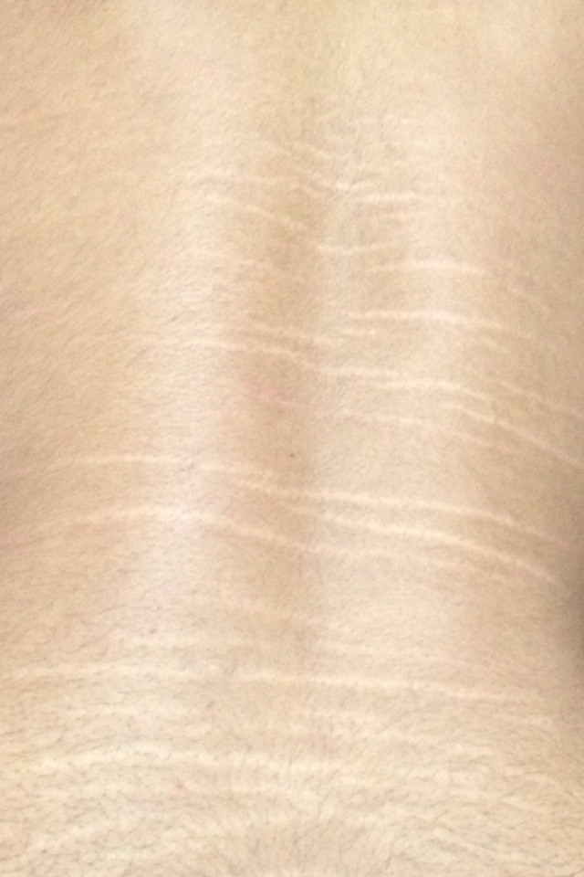 Hautrisse am rücken (Gesundheit, Haut)