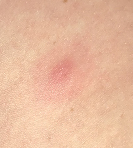 Coin Like Rash Zeckenbiss - die meistgelesenen Fragen