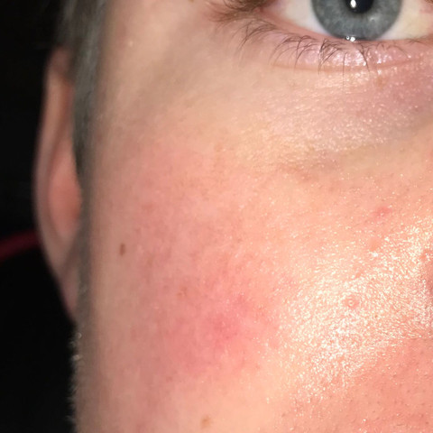 Hautrotung Im Gesicht Wange Gesundheit Und Medizin Akne Rot