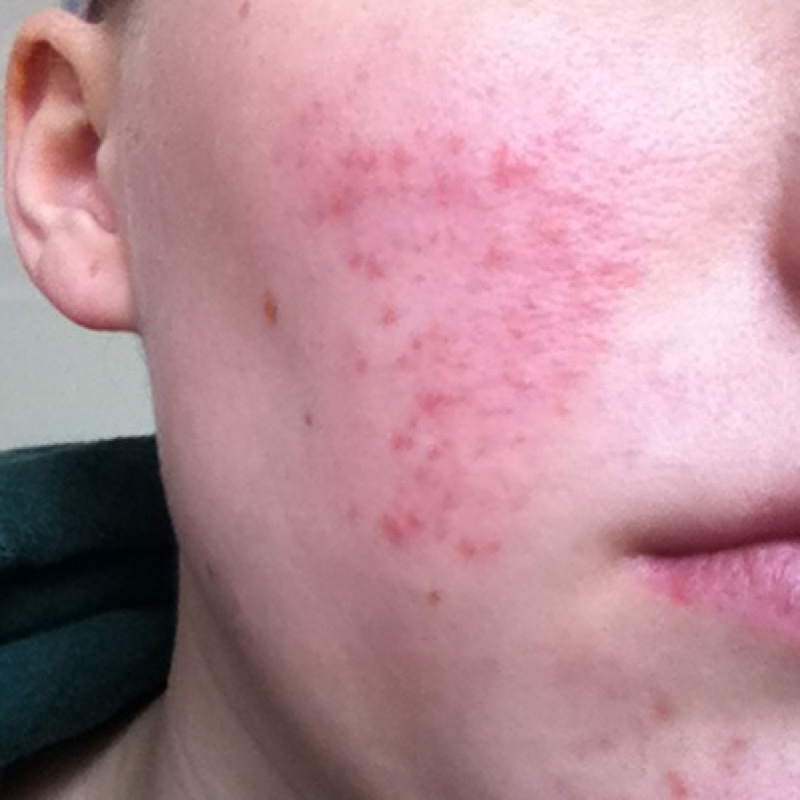 Hauttötungen an Kinn, Wangen und Stirn? Was kann ich tun? (Haut, Pickel, Rötung) pickel im wangenbereich