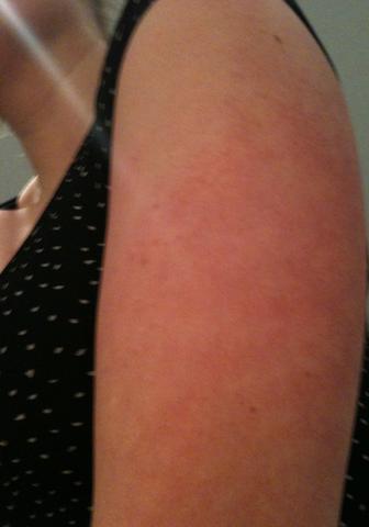 Mein linker Oberarm - (Dermatologie, Hautprobleme)