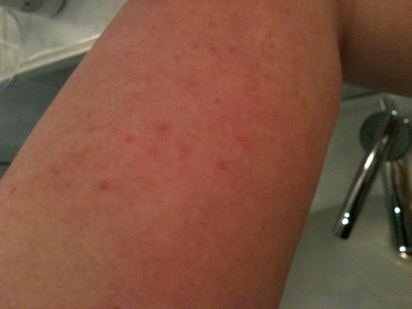 Noch einmal fokussiert - (Dermatologie, Hautprobleme)