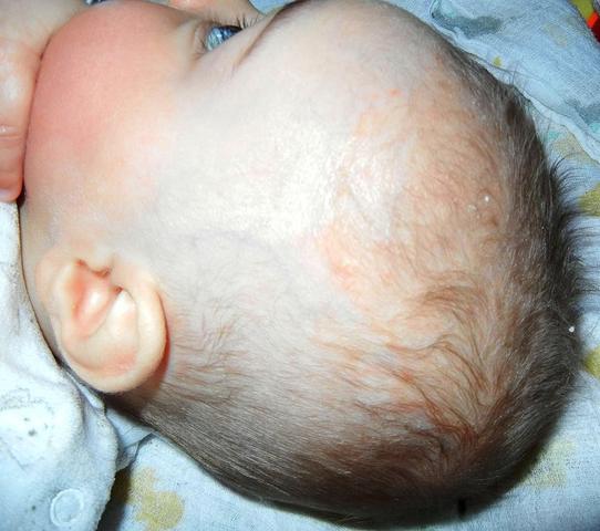 Bild 2 - (Baby, Allergie, Hautarzt)