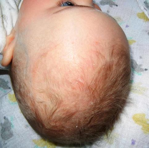 Bild 3 - (Baby, Allergie, Hautarzt)