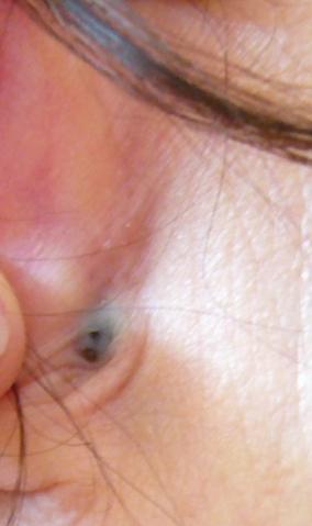 Hautveranderung Hinterm Ohr Gesundheit Blauer Fleck Hautveranderung Hinterm Ohr Gesundheit Blauer Fleck