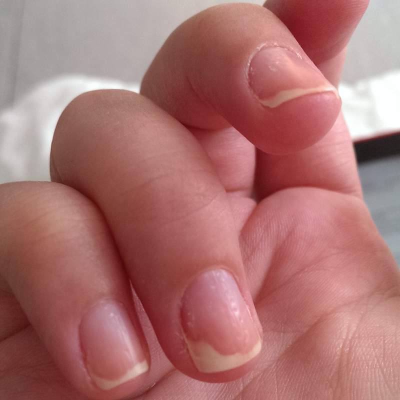 Hautveränderungen besonders am Nagel, Nagelplatt löst sich, keine Naglhaut, Gelb und Empfindlich Hautveränderungen besonders am Nagel, Nagelplatt löst sich, keine Naglhaut, Gelb und Empfindlich