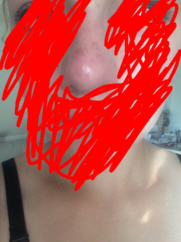 Nase - (Pickel)