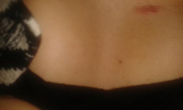 He Habe Das Seit Ein Paar Tagen Auf Der Haut Unter Der Brust Unter Der Achsel Und Am Hals Ist Das Pilz Ekzem Oder Ahnliches Pilze Hautpilz Hefepilz He Habe Das Seit Ein Paar Tagen Auf Der Haut Unter Der Brust Unter Der Achsel Und Am Hals Ist Das Pilz Ekzem Oder Ahnliches Pilze Hautpilz Hefepilz