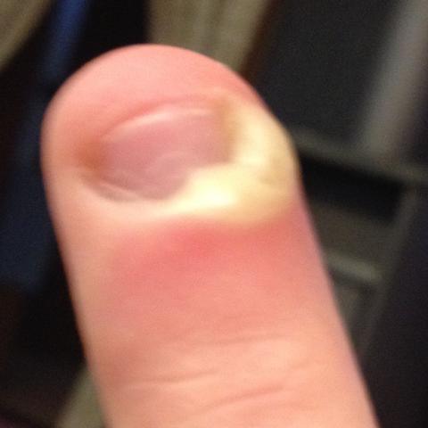 Mein Finger - (Arzt, Schmerzen, Entzündung)