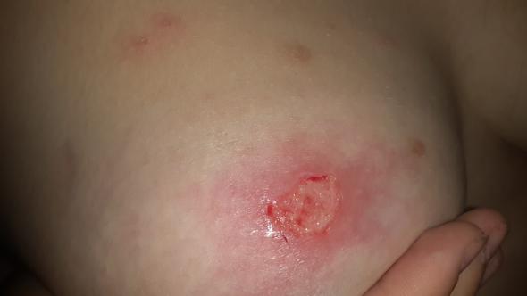 Heftige Entzundung Wegen Muckenstich Was Tun Brust Mueckenstich Schmerzhaft Heftige Entzundung Wegen Muckenstich Was Tun Brust Mueckenstich Schmerzhaft
