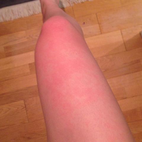 Hei Brauch Mal Rat Beine Rote Flecken Hei Brauch Mal Rat Beine Rote Flecken