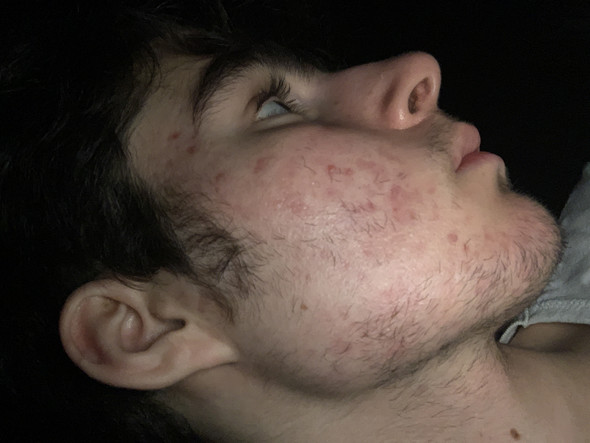 Aknenormin nach absetzen der pille