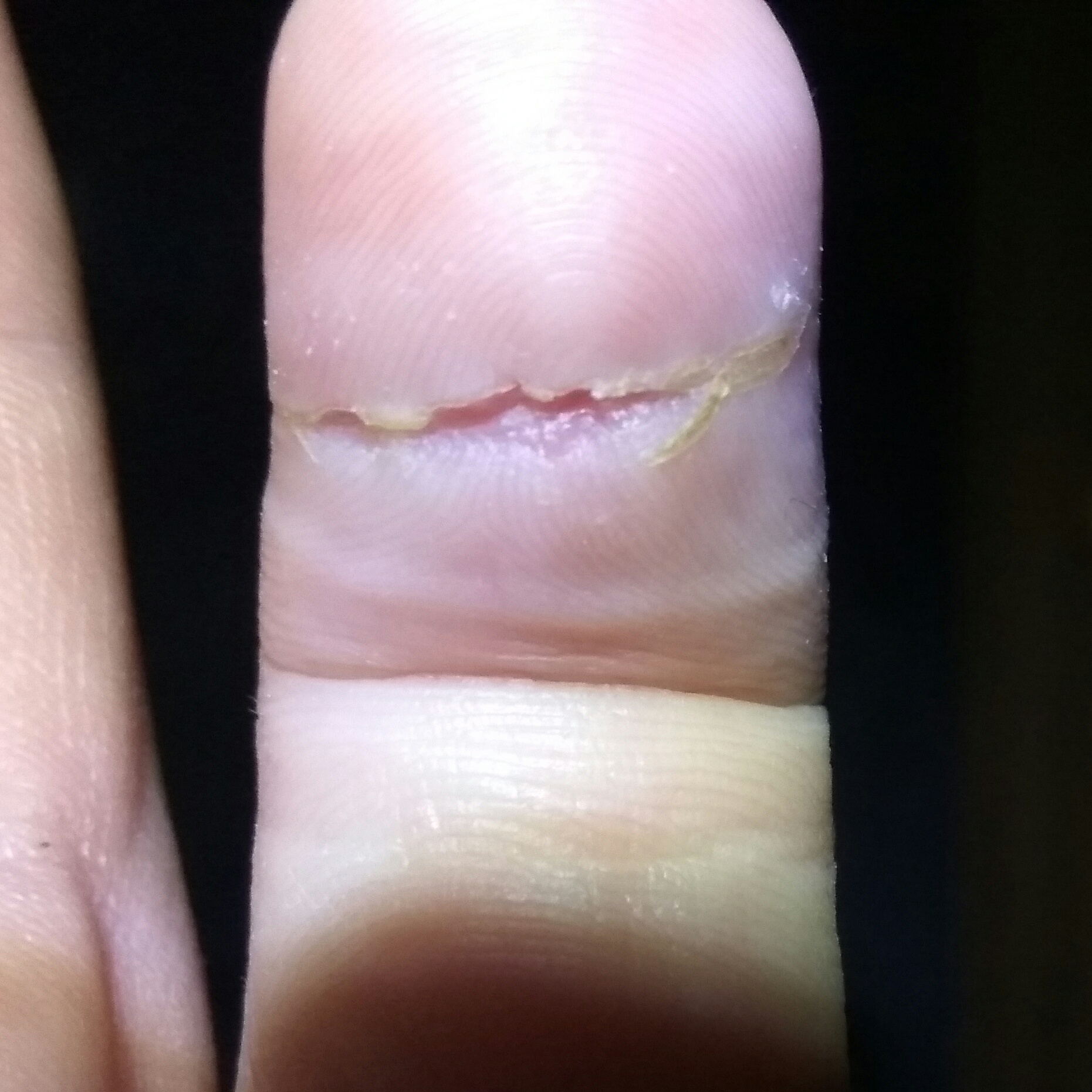 Heilt mein Finger noch weiter (Schnittwunde)? (Medizin, Hand, Heilung) Heilt mein Finger noch weiter (Schnittwunde)? (Medizin, Hand, Heilung)